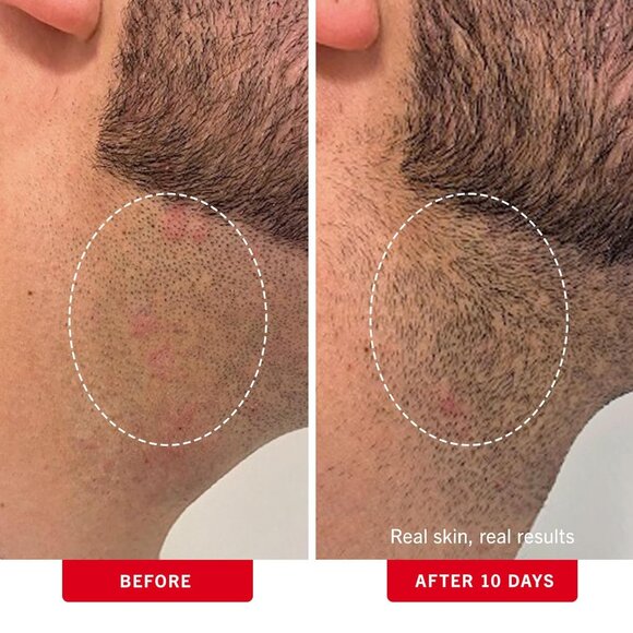 Ingrown Hair Pads with BHA + AHA - Aftershave Treatment Pads to Help Prevent Raz - Picture 4 of 10